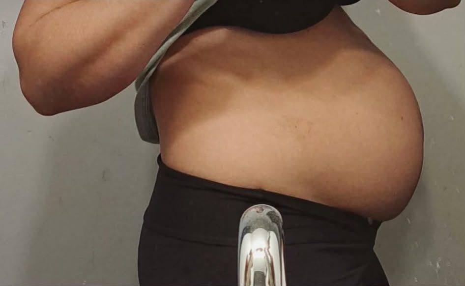 Abdominal wall in profile at the beginning of the rehabilitation work